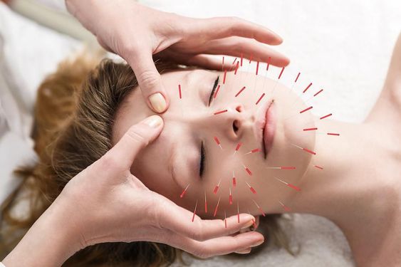 ACUPUNTURA FACIAL